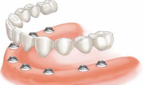Illustration of an all-on-eight dental procedure done by the Costa Rica Dental Center in San Jose, Costa Rica.  The picture shows an all-on-eight being placed in the lower jaw.