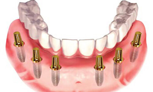 Illustration of an All-on-Six dental procedure done by the Costa Rica Dental Center in San Jose, Costa Rica.  The picture shows an All-on-Six placed in the lower jaw.
